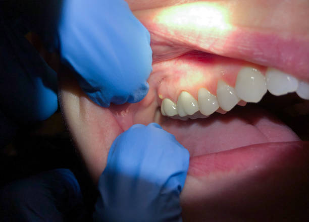 Best Emergency Treatment for Toothache in Canton, IL